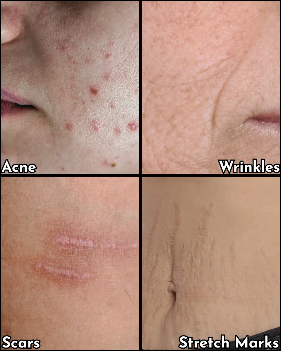 Microneedling (1) Ear Piercing
