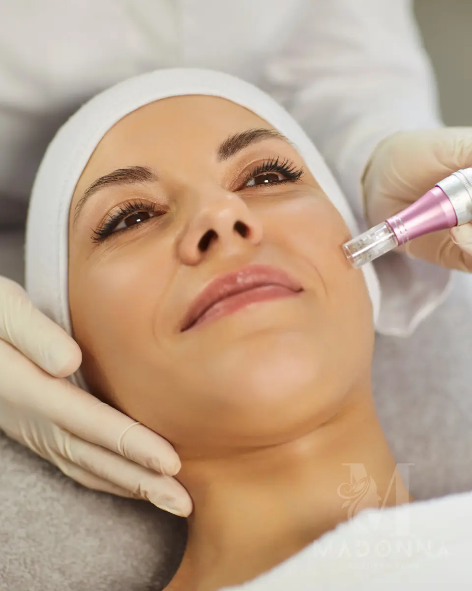 Microneedling-Madonna Beauty Salon Ear Piercing