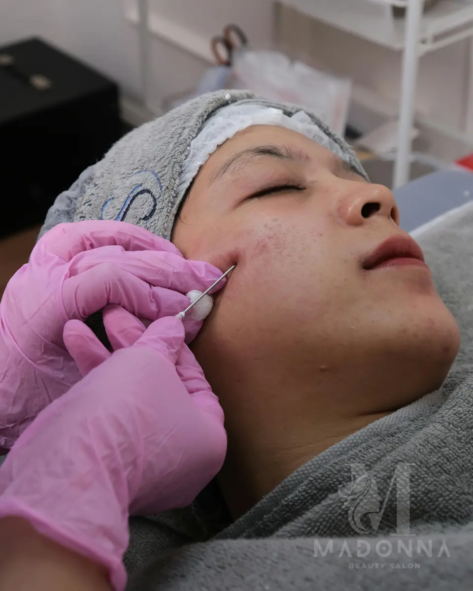 Microneedling-Session Ear Piercing