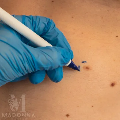 skin-tag-removal Grey Hair Blending